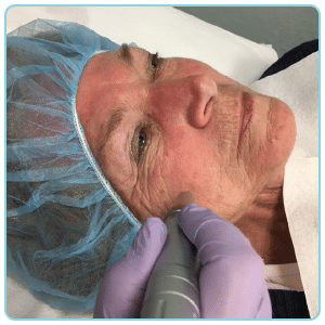 PRP and microneedling treatment for skin